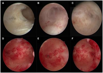 Application of autologous platelet-rich gel formed by calcium gluconate combined with hormone therapy for endometrial repair after hysteroscopic transcervical resection of adhesion surgery and successful pregnancy: case report and literature review